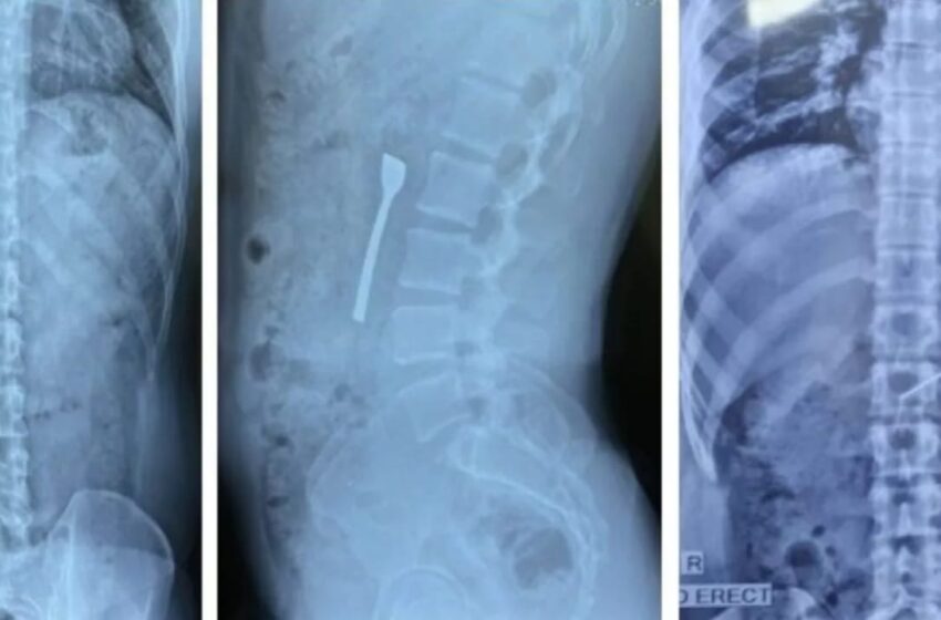  डॉक्टरों ने 30 मिनट में किया बड़ा कमाल, युवक के पेट से निकाली 8 सेमी लंबी चम्मच; जानिए आखिर कैसे गई अंदर?